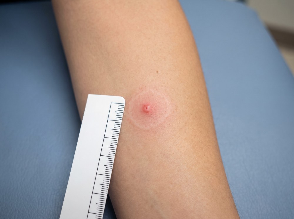 Close-up photograph of a fresh black widow spider bite showing small red fang marks with a pale halo and mild surrounding redness