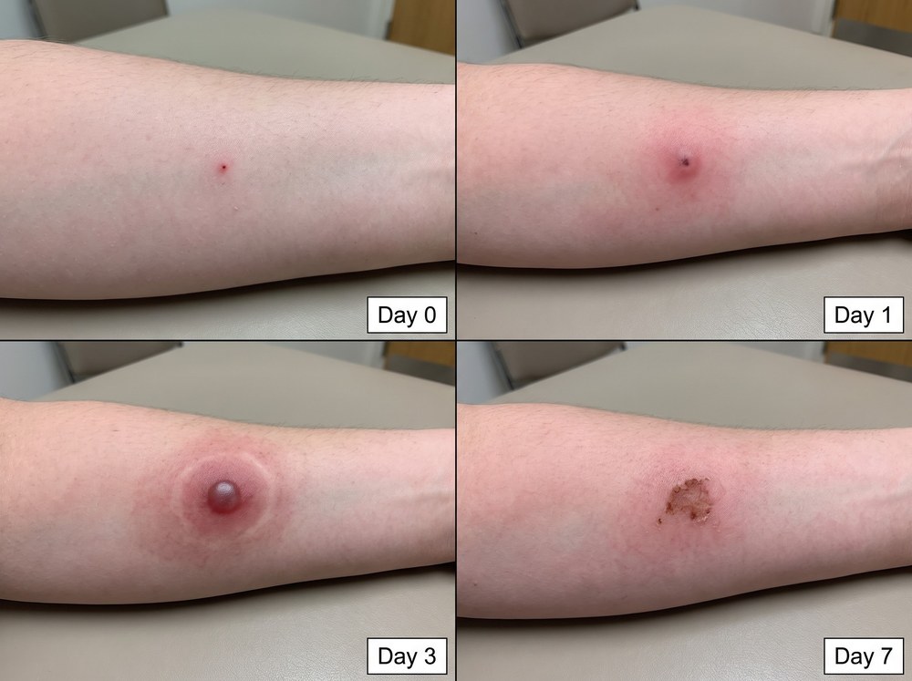 Four-panel progression photo series showing a black widow bite site healing from day zero through day seven